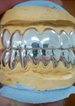 Гриллз – современный тренд в эстетической «ювелирной» стоматологии